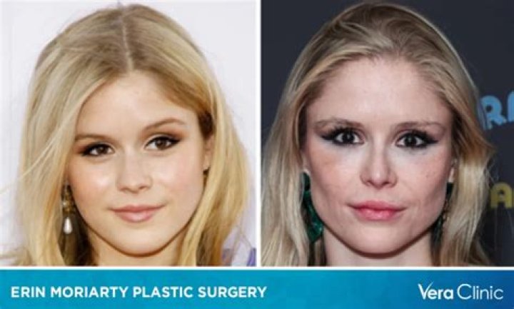 Erin Moriarty | Plastic Surgery Before And After