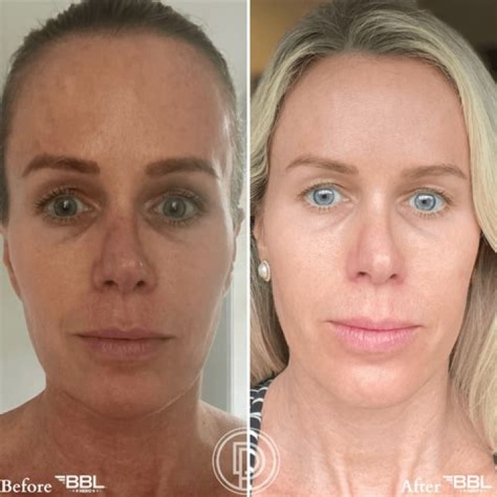 Himynamestee BBL Surgery | Before And After Photos
